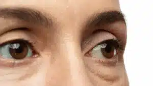 Mixedema